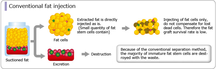 Conventional fat injection