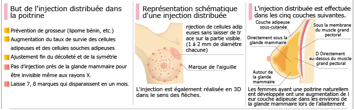 But de l'injection distribuée dans la poitrine