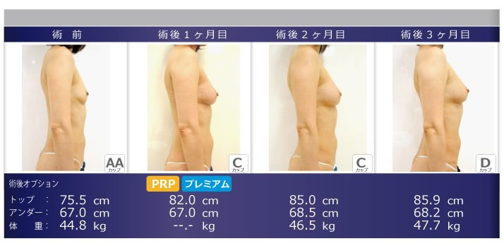 術後も成長する豊胸術 症例 04 最新美容医療特集 豊胸 脂肪注入kunoクリニック 大阪 梅田 美容整形 美容外科